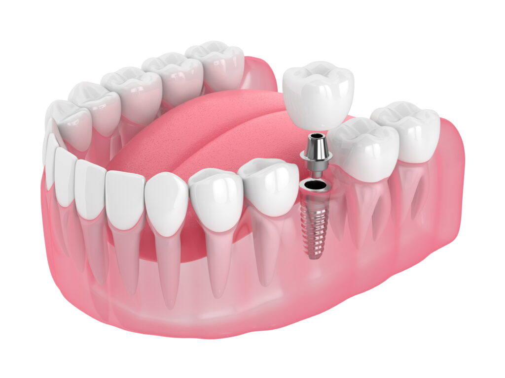 West wind dental implant 2