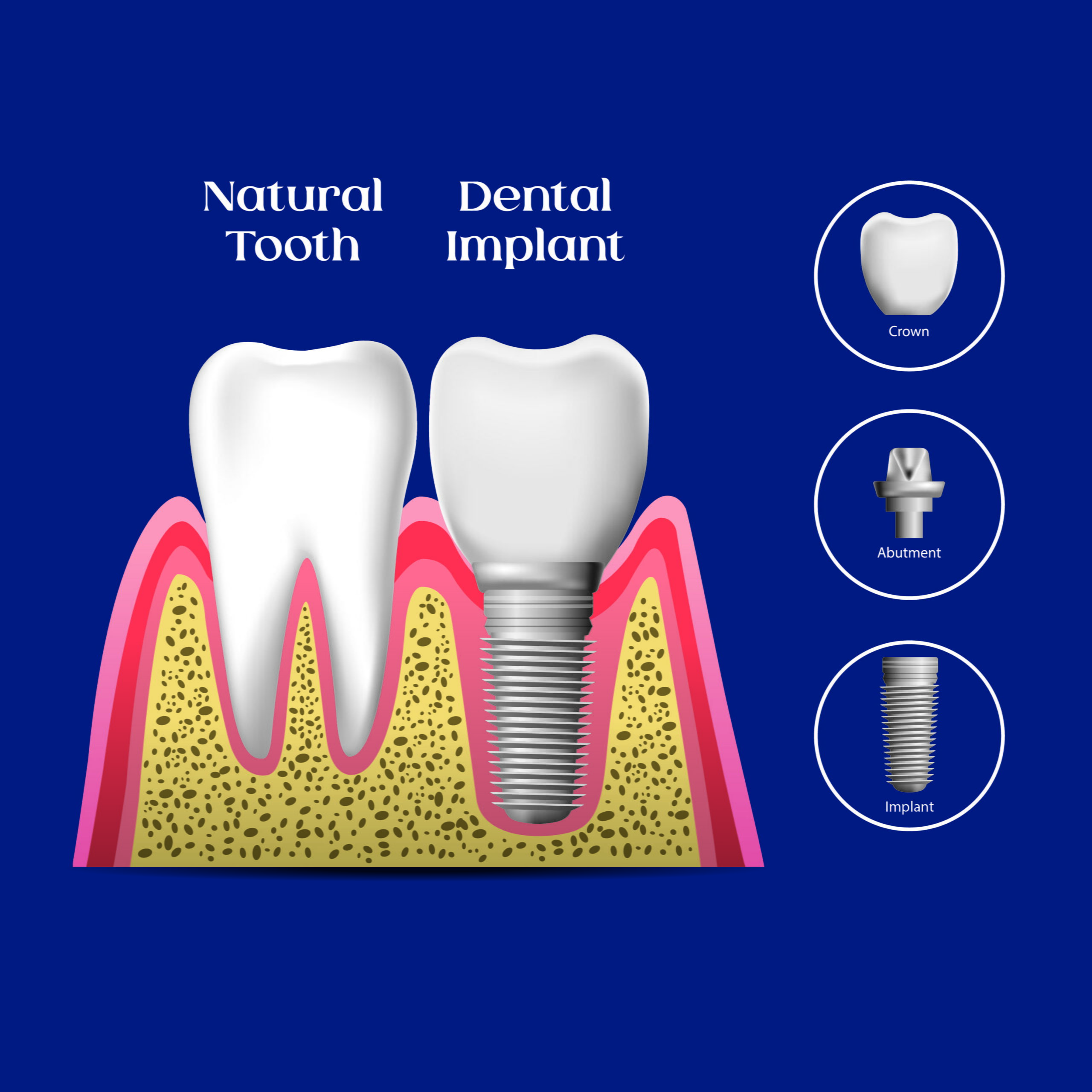 What Are Dental Implants? - West Wind Dental