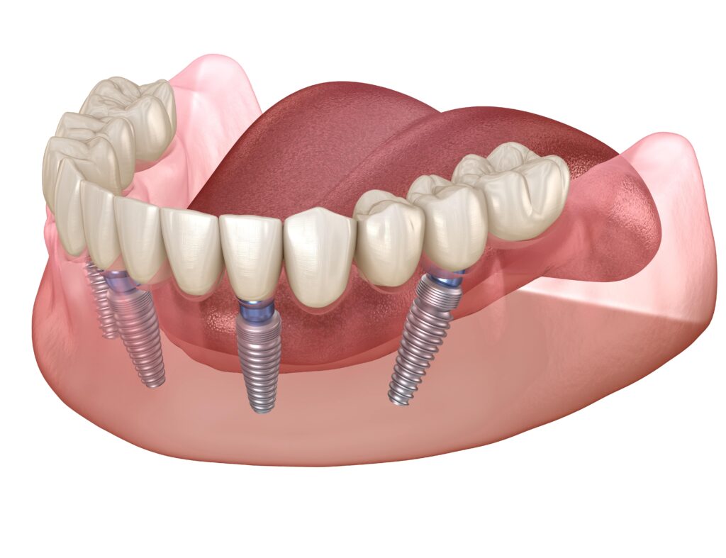 Diagram of All-on-4 dental implants.