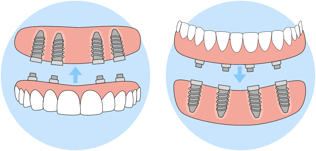 An illustration of the post system used when you get new teeth now.