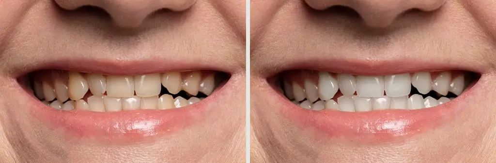Teeth whitening before and after close up