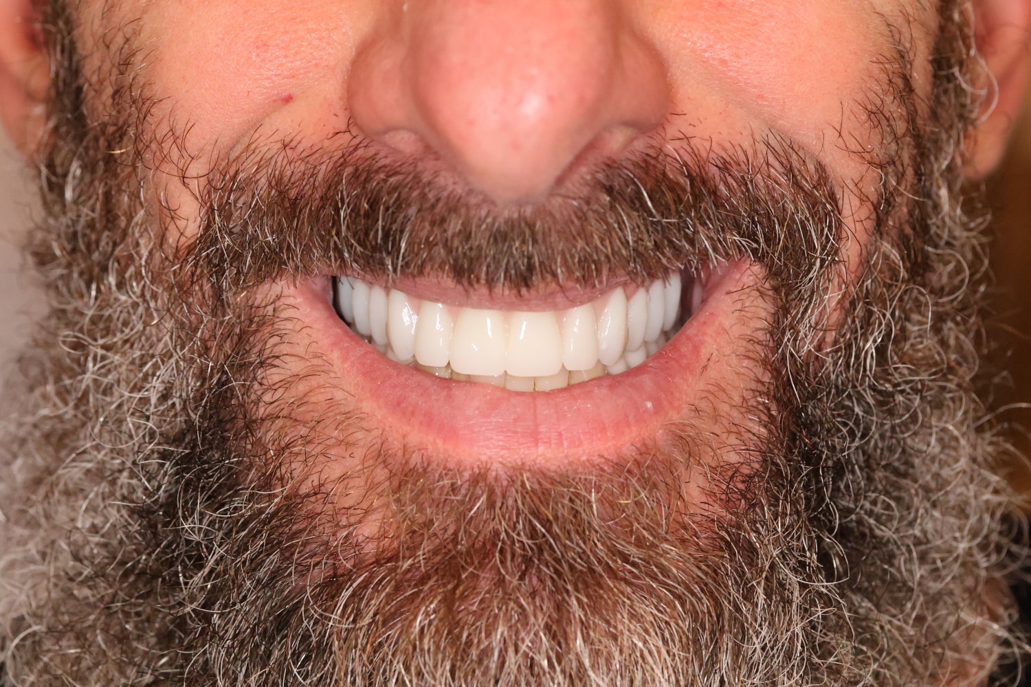 John, a patient of West Wind Dental, after receiving dental implants.
