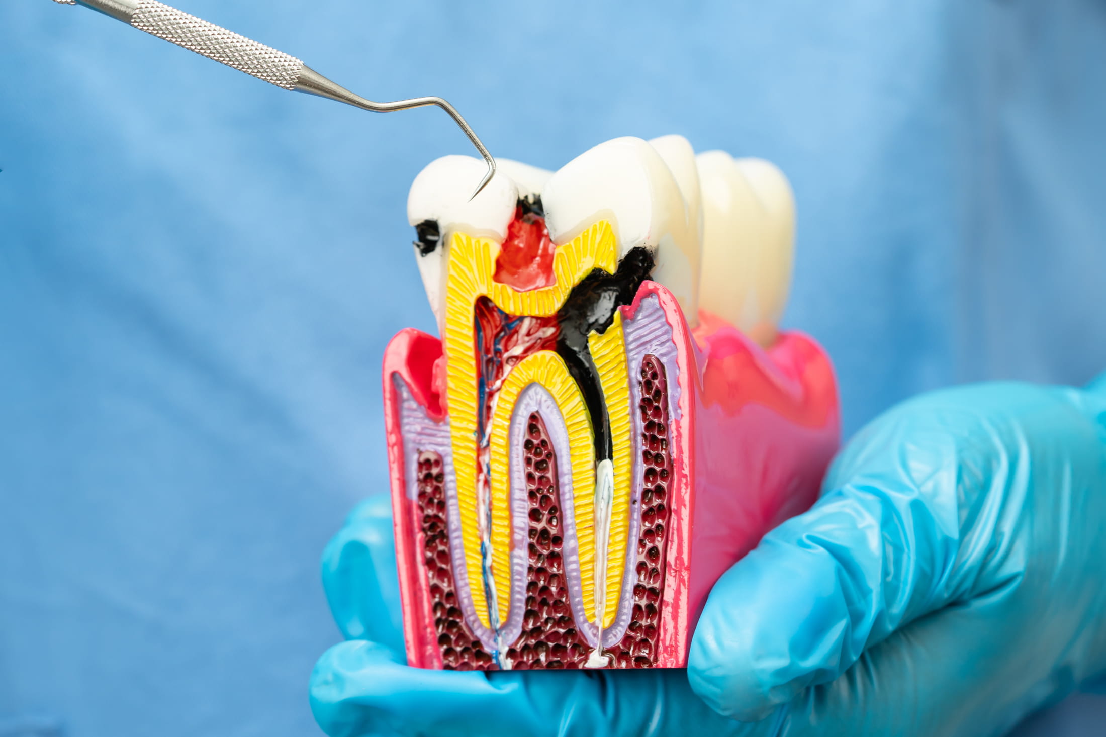 A dentist indicating on a model tooth what a cavity looks like.